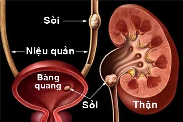 Chế độ ăn uống lành mạnh, cân bằng có thể giúp bạn tránh bị sỏi.